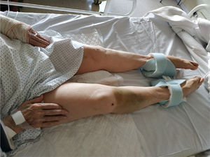 Hiperextensión de manos y pies en relación con la hipocalcemia.