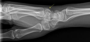 Radiografía convencional lateral de muñeca, con prominencia ósea en la base del 3.° metacarpiano (flecha).