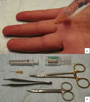a) Lugar de punción anestésica. b) Material necesario para el procedimiento de reparación.