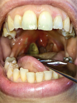 Angina ulceronecrótica de Plaut-Vincent.