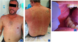 a y b: exantema maculopapular eritematoso confluente de predominio en las regiones facial y cervical, y el tronco. c: máculas gris-blanquecinas dispersas a nivel de la mucosa yugal.
