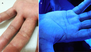 A) Detalle de las lesiones hiperqueratósicas filiformes. B) Fluorescencia blanca de las lesiones con luz de Wood.