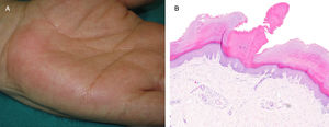 A) Discretas lesiones hiperqueratósicas puntiformes a nivel palmar. B) Columna de paraqueratosis sobre una epidermis con ausencia de capa granular (hematoxilina-eosina ×4).
