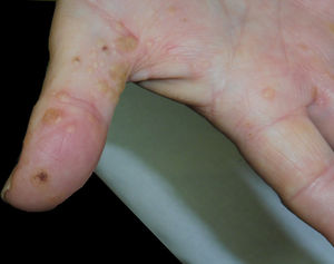 Pápulas queratósicas múltiples en palma y cara lateral de los dedos con punteado hemorrágico correspondientes con verrugas vulgares.