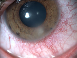 Varón de 30 años usuario de lentes que contacto con queratitis infecciosa en su ojo derecho. El cultivo microbiológico, sin embargo, fue negativo. Imagen cortesía de la Dra. Anna Camòs.