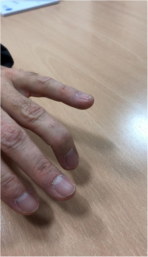 Rotura del tendón extensor largo del 4.° dedo.