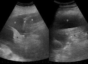 Ecografía pulmonar: se observa el bazo (B), diafragma (d) y derrame pleural (D) con una brida en su interior. En la imagen izquierda se observa, más en profundidad, una imagen hiperecogénica en forma de lengüeta que corresponde al lóbulo inferior atelectásico (A). En la imagen derecha se aprecia la neumonía (N).