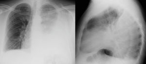 Radiografía PA y lateral de urgencias: derrame pleural izquierdo.