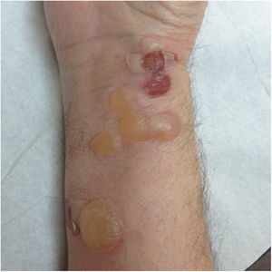 Penfigoide ampolloso: ampollas tensas de contenido seroso sobre base urticariforme.