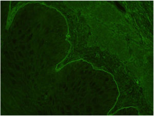 Inmunofluorescencia indirecta positiva: depósitos de anticuerpos circulantes anti-membrana basal en subepidermis.