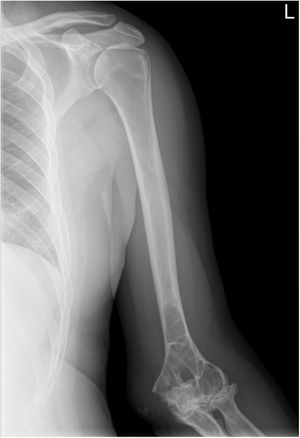 Radiografía anteroposterior de la extremidad superior izquierda en la que se aprecia una lesión lítica que afecta al tercio distal del húmero, cambios degenerativos en las interlíneas húmero-cubital y húmero-radial, y nódulo de 2,4×5cm en la vertiente posterior de la epitróclea, compatible con absceso.
