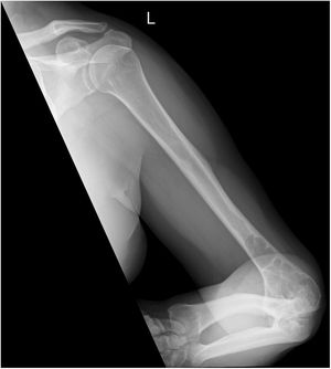Radiografía lateral de la extremidad superior izquierda en la que se aprecia una lesión lítica que afecta al tercio distal del húmero y cambios degenerativos en las interlíneas húmero-cubital y húmero-radial.