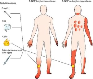 Diferencias de distribución anatómica entre la neuropatía de fibras pequeñas longitud-dependiente y no longitud-dependiente. Tomada de Tekelsen et al.3.