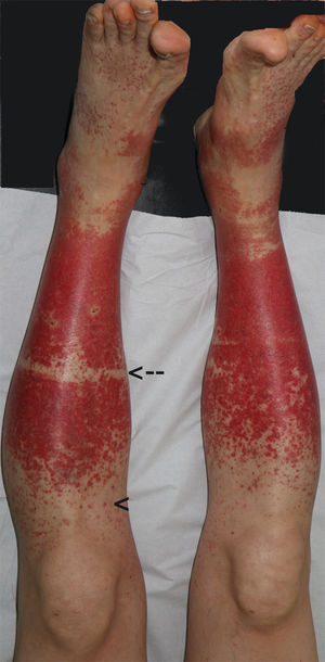 Imagen clínica de las lesiones del paciente. Presencia de múltiples petequias puntiformes (cabeza de flecha) a nivel del tercio distal y medio de las piernas, que confluyen para formar una mancha purpúrica, sin progresión a zonas proximales. Se produce un respeto de las zonas en las que el paciente llevaba prendas ajustadas (flecha).