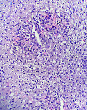 Intenso infiltrado linfocitario en la región peripapilar del esófago (hematoxilina-eosina, 40×).