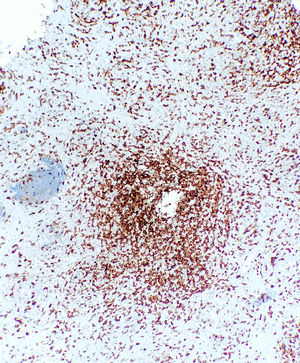 Tras el marcaje con anticuerpos CD3, se identifica que la mayoría de los linfocitos que infiltran el esófago corresponden a linfocitos T.
