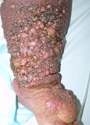 Miembro inferior edematoso con superficie cutánea de aspecto verrucoso.