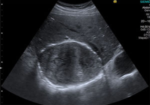 Imagen ecográfica del quiste en el lóbulo hepático izquierdo.