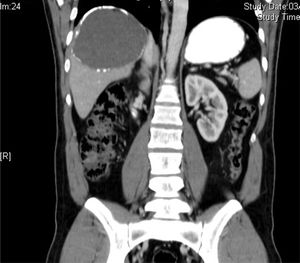 Corte coronal de la TC abdominal con lesión quística en el segmento 7 hepático.