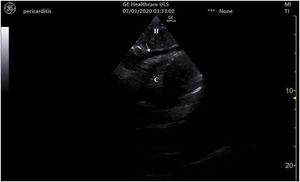 Sonda sectorial. Vista subxifoidea de 4 cámaras. Se observa banda anecoica (flecha) que separa el pericardio parietal del miocardio alrededor del corazón (C) en diástole. H: hígado.