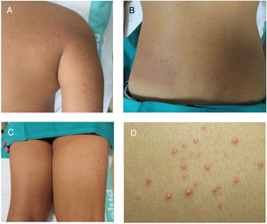 Pápulas monomorfas, eritemato-amarillentas de 2-4mm de diámetro, de superficie lisa y consistencia firme. A) Hombro derecho. B) Región lumbar. C) Región glútea. D) Detalle de las lesiones.