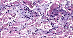 Histiocitos de citoplasma espumoso, entremezclados con otros elementos inflamatorios, predominantemente linfocitos (hematoxilina-eosina, ×40).