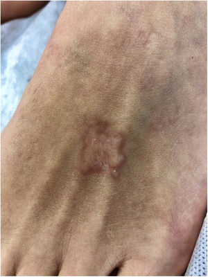 Placa eritematosa de bordes sobreelevados bien definidos y centro atrófico con telangiectasias en superficie.