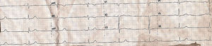 Electrocardiograma del paciente al ingreso en el consultorio de medicina interna, mostrando bradicardia sinusal con bloqueo auriculoventricular de primer grado.