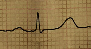 Ampliación de la derivada D II del electrocardiograma del paciente al ingreso en el consultorio de medicina interna, mostrando bloqueo auriculoventricular de primer grado.