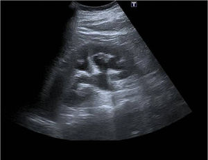 Ecografía donde se observa dilatación de los 3 sistemas colectores y la pelvis renal izquierda.
