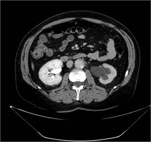 Tomografía computarizada donde se observa dilatación pielocalicial del riñón izquierdo y una masa de partes blandas que rodea a la aorta.