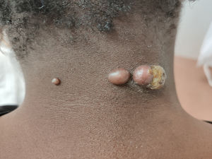 Lesiones nodulares de color piel en la zona cervical posterior.