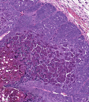 Detalle de la biopsia cutánea teñida con hematoxilina y eosina en la que se identifican cuerpos de inclusión eosinofílicos citoplasmáticos.