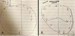 Test del reloj realizado por el paciente en el momento del diagnóstico de deficiencia de vitamina B12 (A), y un año después de la suplementación (B).