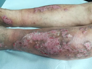 Lesiones de prurigo nodular en región anterior de ambas piernas.