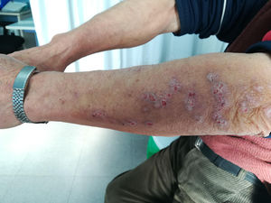 Lesiones de prurigo nodular en superficie extensora de antebrazo izquierdo.