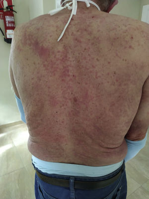 Lesiones en tronco.