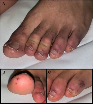 Lesiones de aspecto perniosiforme. (A) Pápulas eritemato-violáceas edematosas, distribuidas simétricamente en falanges distales de dedos de ambos pies. (B, C) Detalle de lesiones purpúricas de aspecto isquémico-hemorrágico en primer y quinto dedos de pie izquierdo.