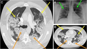 A) Radiografía de tórax de un paciente con COVID-19. Las flechas verdes marcan opacidades asimétricas irregulares en ambos campos pulmonares. B)Tomografía de tórax de un paciente con COVID-19, etapa inicial. Las flechas amarillas marcan consolidaciones, las flechas naranjas marcan consolidaciones en vidrio esmerilado. C)Tomografía de tórax de un paciente con COVID-19, etapa tardía. Las flechas amarillas marcan consolidaciones, las flechas naranjas marcan consolidaciones en vidrio esmerilado con patrón reticular e importante distorsión anatómica. Fuente: Imágenes obtenidas mediante consentimiento de paciente salvaguardando su identidad.