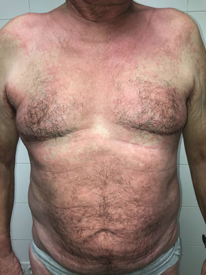 Erupción maculopapular que afecta predominantemente al tronco, donde es confluyente. Nótese la afectación flexural en cuello y axilas.