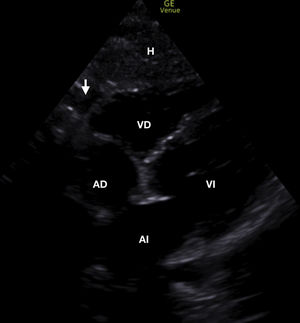 Sonda sectorial. Vista subxifoidea. Se observa estructura anecoica entre el hígado (H) y el ventrículo derecho (VD), correspondiente con un leve derrame pericárdico (flecha).