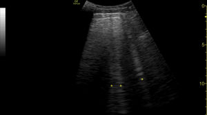 Sonda cónvex. Vista longitudinal en hemitórax derecho anterior. Se observan múltiples líneas B (asterisco) correspondientes con afectación pulmonar por COVID-19.