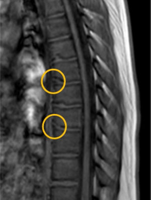 Resonancia magnética de columna dorsal: irregularidades en las plataformas somáticas con hernias de Schmorl que improntan en la base de algunos cuerpos vertebrales (D6 y D8) e imágenes de seudofracturas límbicas en el borde anteroinferior en D7 y D9 correspondientes a vértebras limbus (destacadas con un círculo).