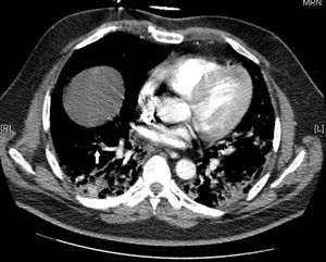 TAC torácica. Imagen compatible con TEP periférico en LID.