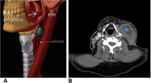 A. Imagen que muestra la anatomía correspondiente a la lesión. B. Imagen de tomografía axial computerizada de cuello en la que se observa la lesión (estrella) correspondiente a quiste del segundo arco braquial, sobreinfectado.