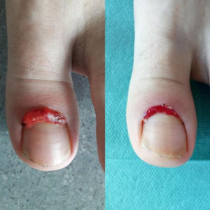 Imagen de la izquierda: aspecto de la lesión en la primera consulta. Imagen de la derecha: aspecto tras una semana de tratamiento.
