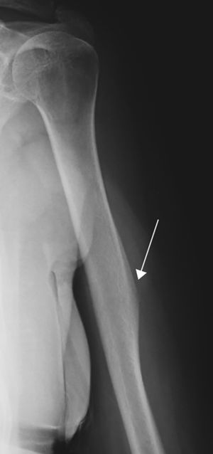 La flecha muestra la apariencia típica del pseudotumor deltoideo.