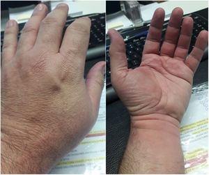Lesiones habonosas en dorso y palma de la mano.