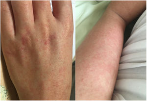 Exantema maculopapular en mano y pierna.