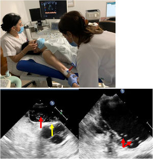 Pruebas diagnósticas en FOP. a) Doppler transcraneal con test de burbujas. b) Ecocardiografía: FOP con aneurisma del tabique interauricular. Izquierda: tabique protruyendo (flecha amarilla) y pase de burbujas a través del FOP (flecha roja). Derecha: aurícula izquierda con numerosas burbujas (flechas). Imágenes cedidas por la Unidad de Ictus y Laboratorio de Neurosonografía. Servicio de Neurología. Unidad de Ecocardiografía. Servicio de Cardiología. Hospital Reina Sofía de Córdoba.